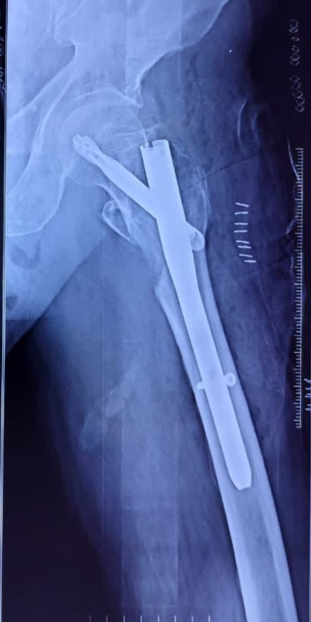 After fracture management example